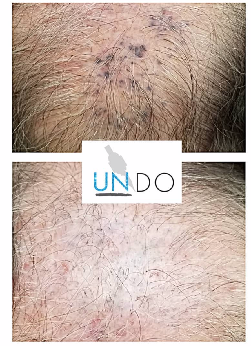 Undo Non-Laser Tattoo Removal Hands-On Training Deposit - Estetiq Boutiq